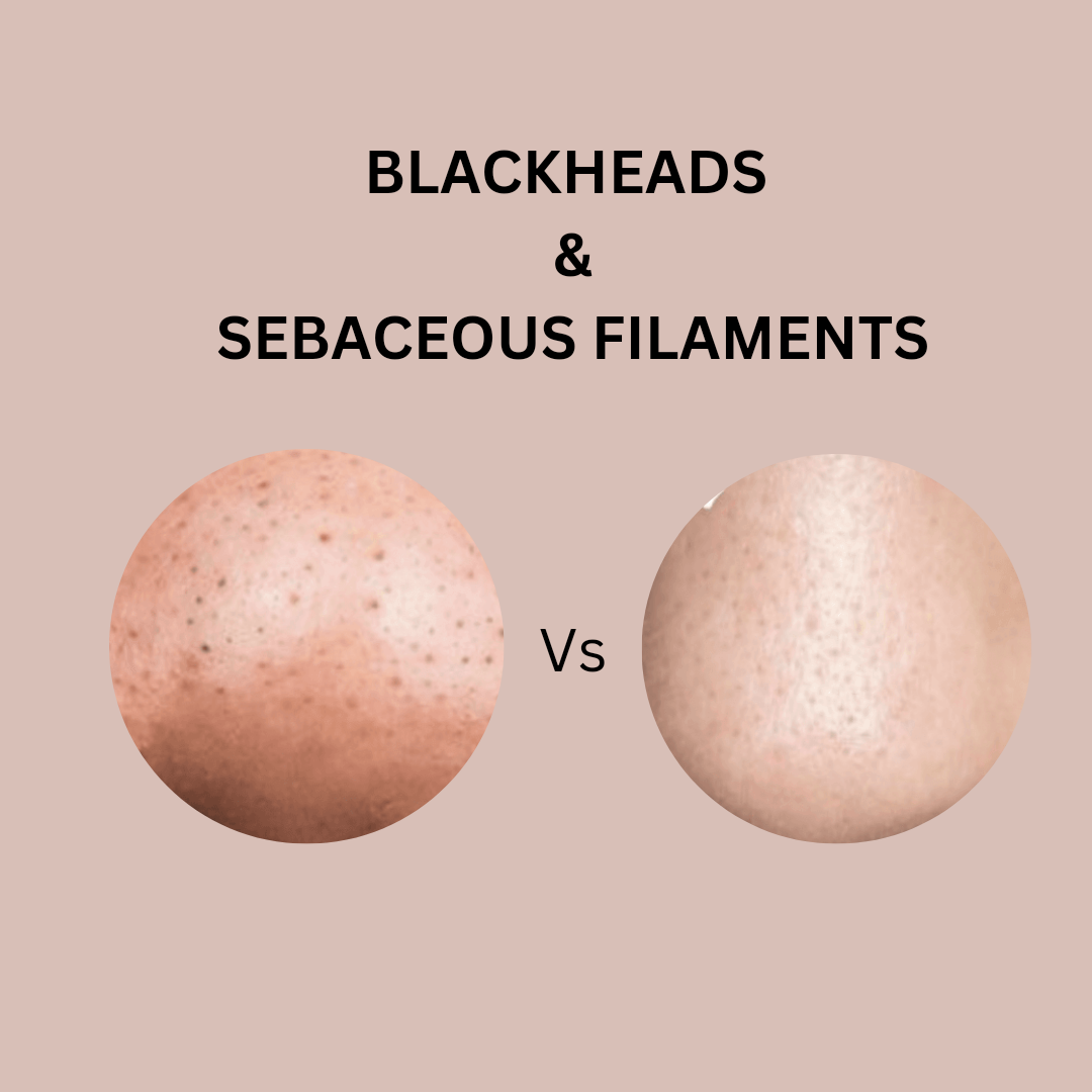 How to Get Rid of Blackheads and Sebaceous Filaments Naturally: A Guide to Caithy Organics Skincare